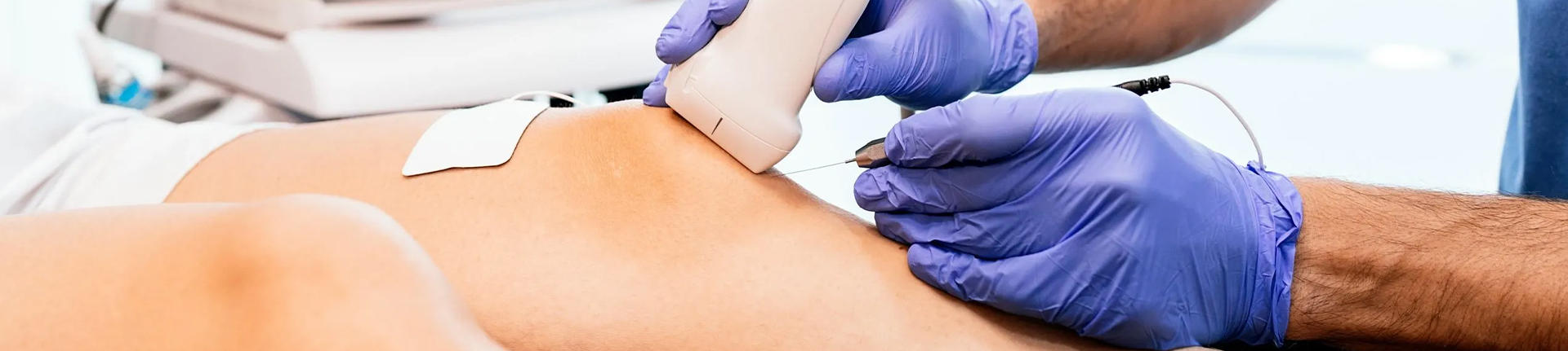 TENJET® Procedure TENJET® Procedure