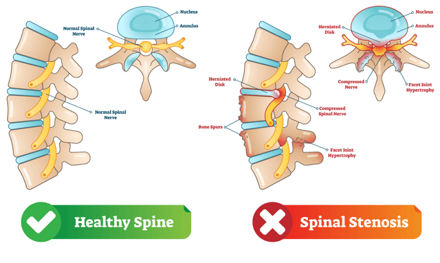 Lumbar Spinal Stenosis Performance Medical Somerset County NJ