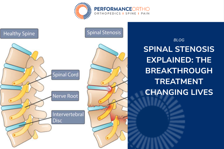 spinal-stenosis-explained-tile